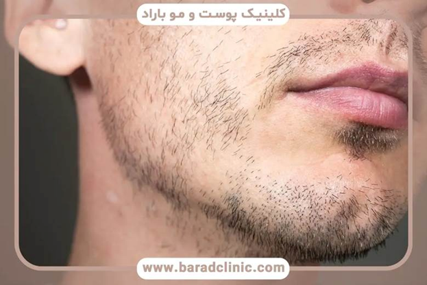 آمادهسازی پوست صورت قبل از کاشت ریش