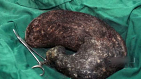 خارج کردن توده موی یک کیلویی از معده نوجوان بجنوردی +فیلم