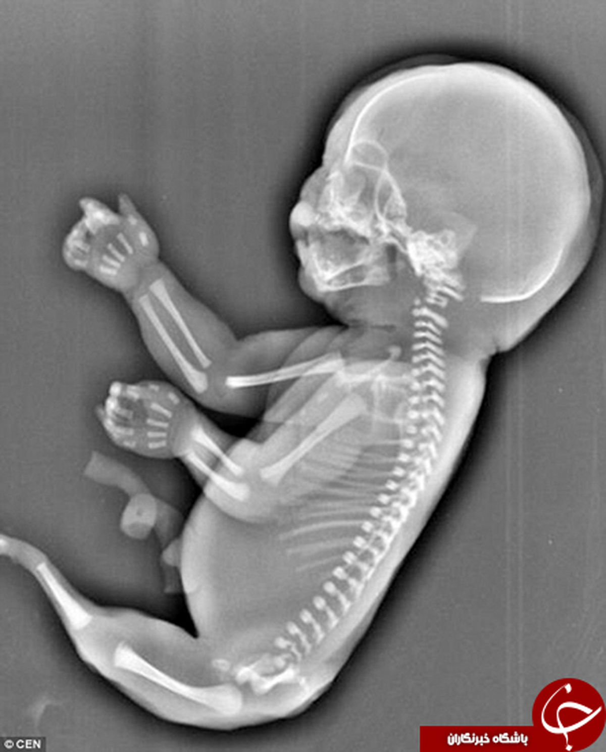 نوزاد پری دریایی قبل از تولد سقط شد +تصاویر