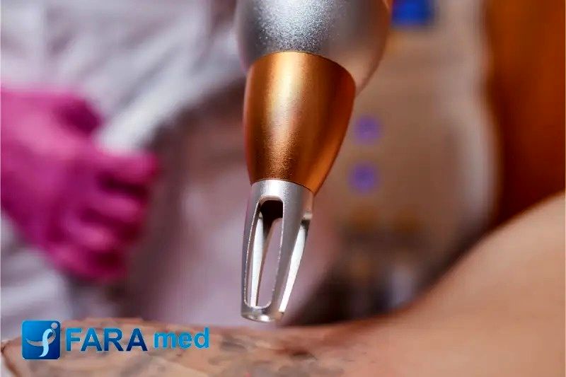 بهترین لیزر برای پاک کردن تتو چیست؟