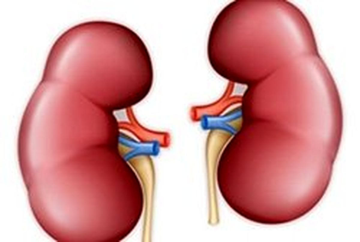 سنگ کلیه در کدام مناطق کشور شیوع بالایی دارد؟