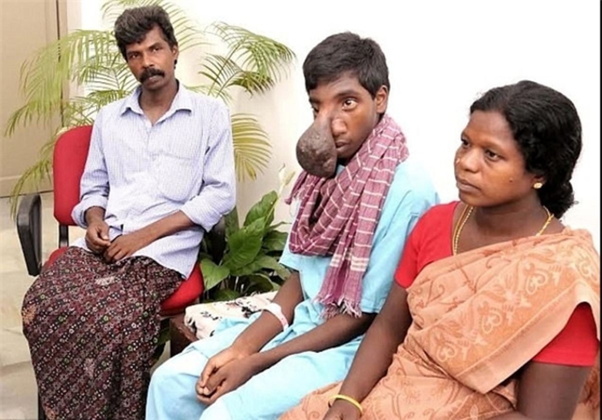 خارج کردن توموری عجیب از صورت پسر هندی +تصاویر