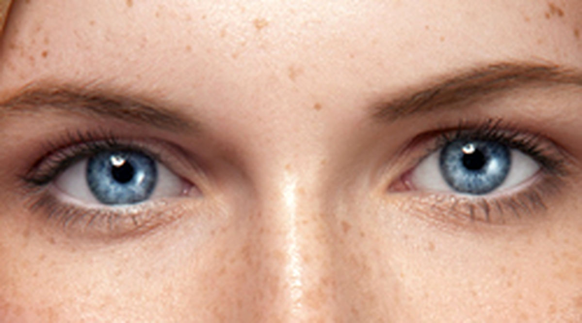 انواع لک پوستی در سنین مختلف