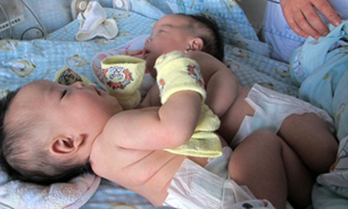 دوقلوهای افسانه‌ای چین جداشدند/تصاویر