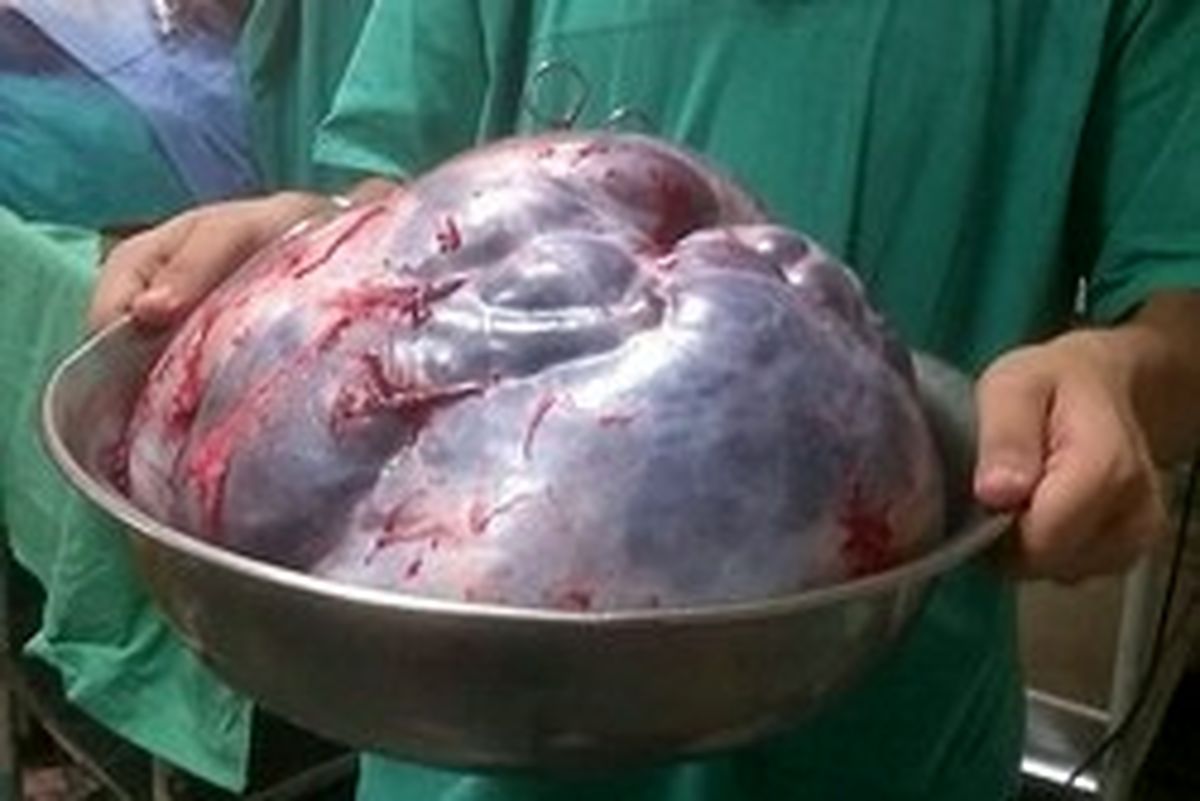 خارج کردن غده ۳۵ کیلویی از شکم زن هندی +تصاویر