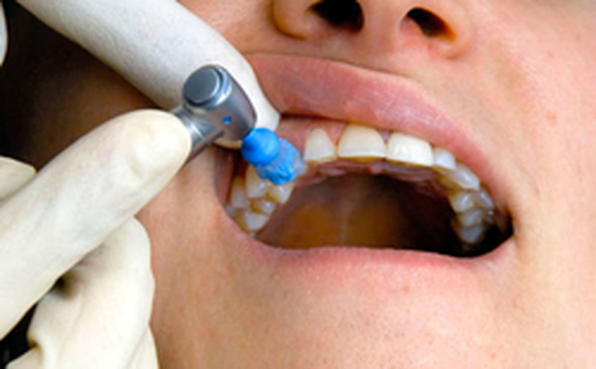 دلایلی که باعث حساسیت دندان ترمیم شده میشود