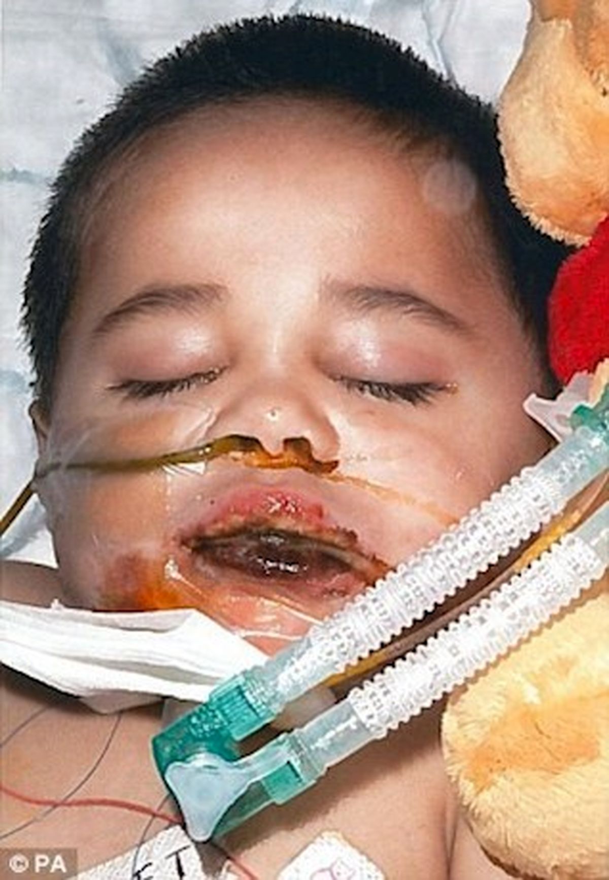 نوشیدن اسید پسربچه را برای همیشه لال کرد +عکس