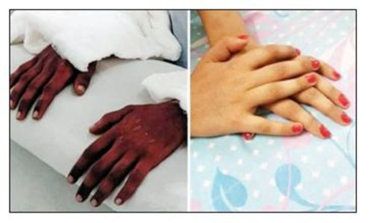 عکس: تغییر رنگ عجیب دست‌های پیوندی