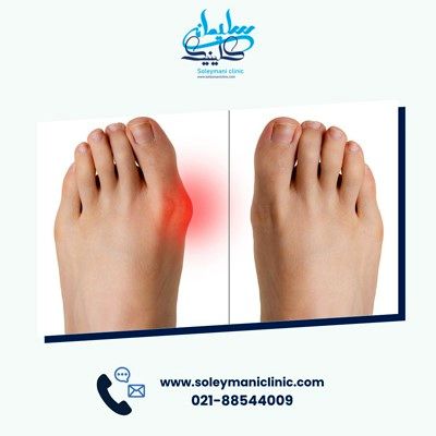 هالوکس والگوس یا عارضه انحراف شست پا چیست