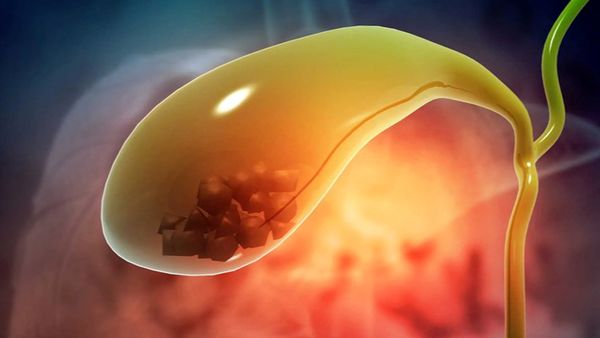 «ماهی خام» سنگ کیسه صفرا را دفع میکند؟