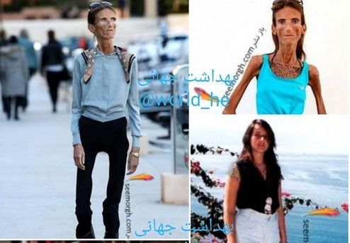 لاغرترین زن جهان فقط ۲۵ کیلوگرم وزن دارد! +عکس