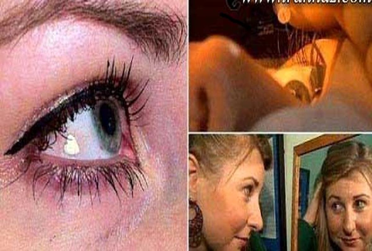 کاشت باورنکردنی جواهر در چشم +عکس