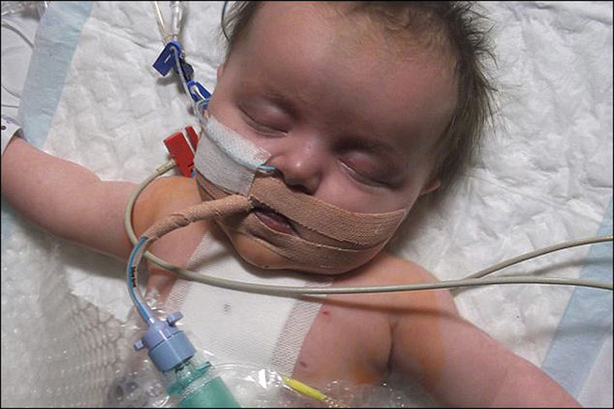 کودکیکه با نصفقلب متولدشد/عکس