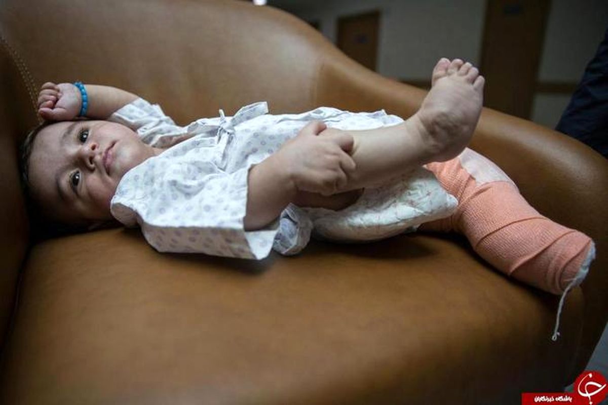 نوزادی با هشت دست و پا زیر تیغ جراحان رفت +عکس