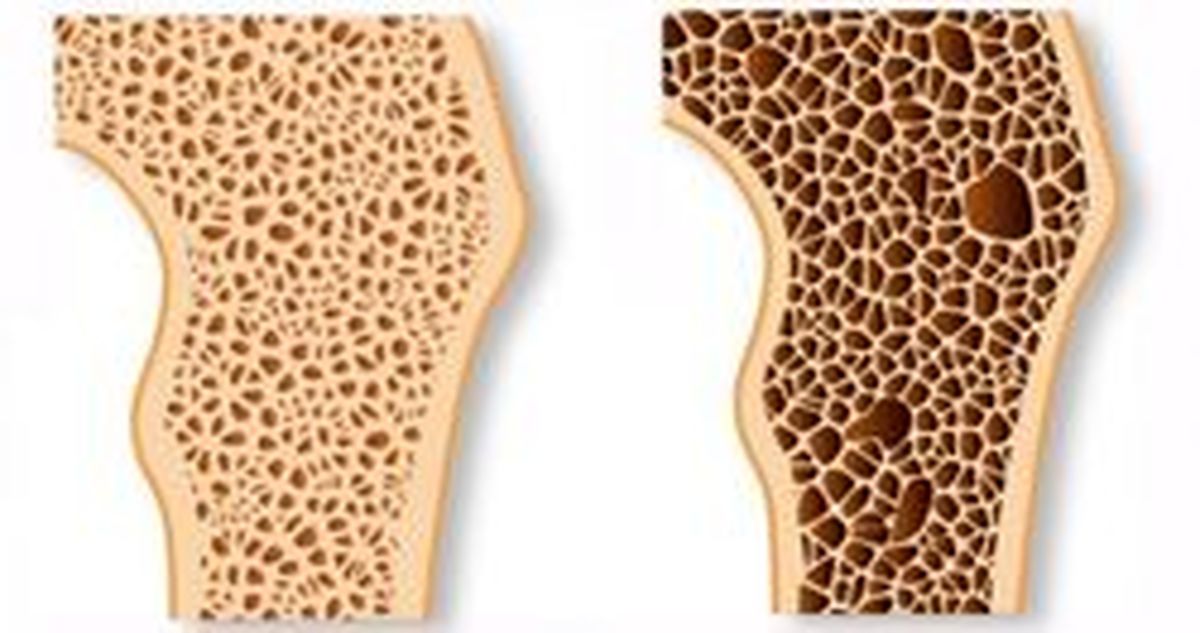 ۱۶ درمان موثر پوکی استخوان