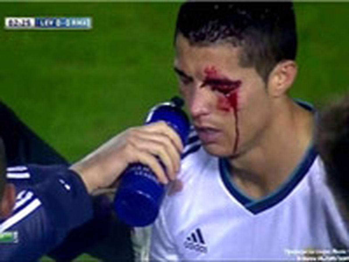 رونالدو مشکل بينايي پيدا کرد/عکس