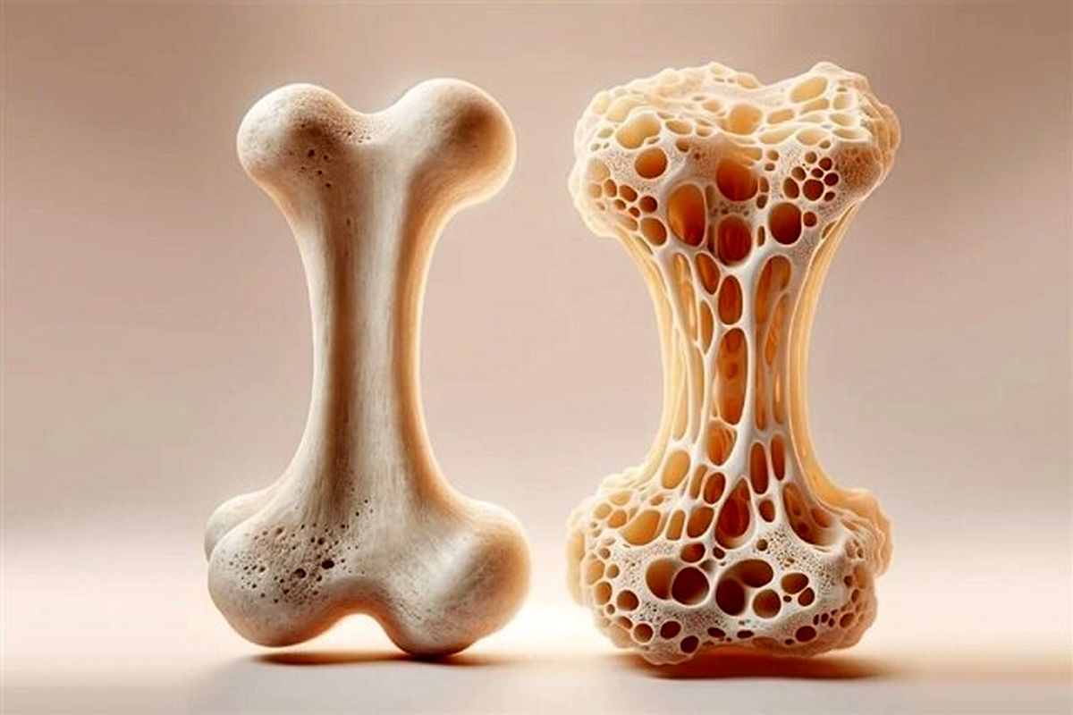 پوکی استخوان فقط برای سالمندان نیست!