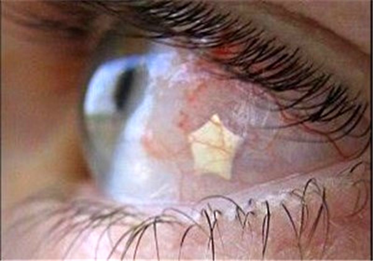 کاشت نگین ۷ میلیونی در چشم/عکس