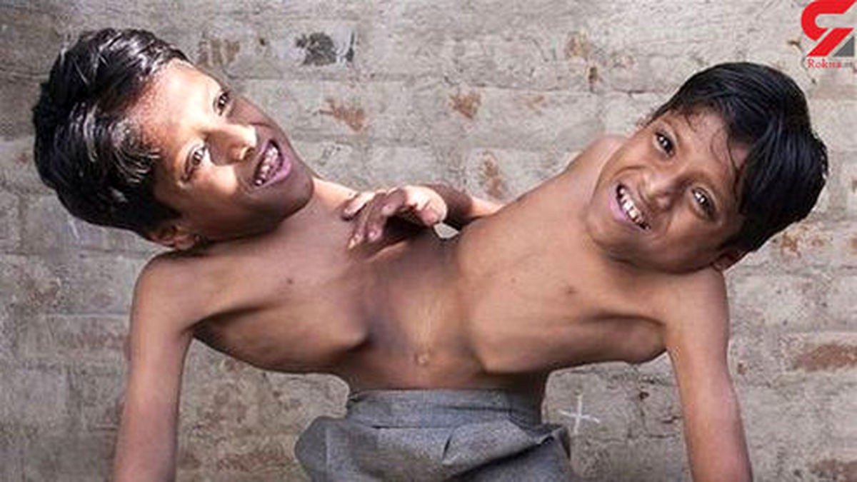 دوقلوهای به هم چسبیده هندی تصمیم گرفتند جراحی نکنند +عکس