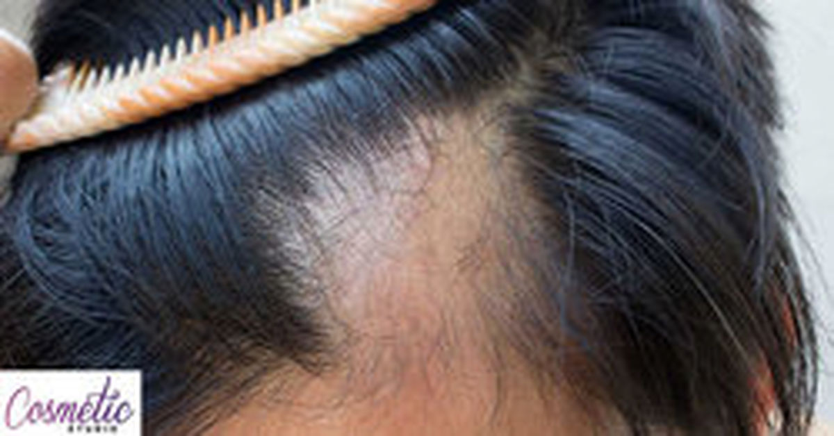 آیا روش‌های درمان ریزش‌ مو مؤثرند؟