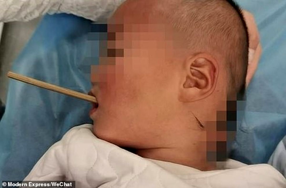 فرو رفتن چوب چاپستیک در گلوی پسر۲ ساله +عکس