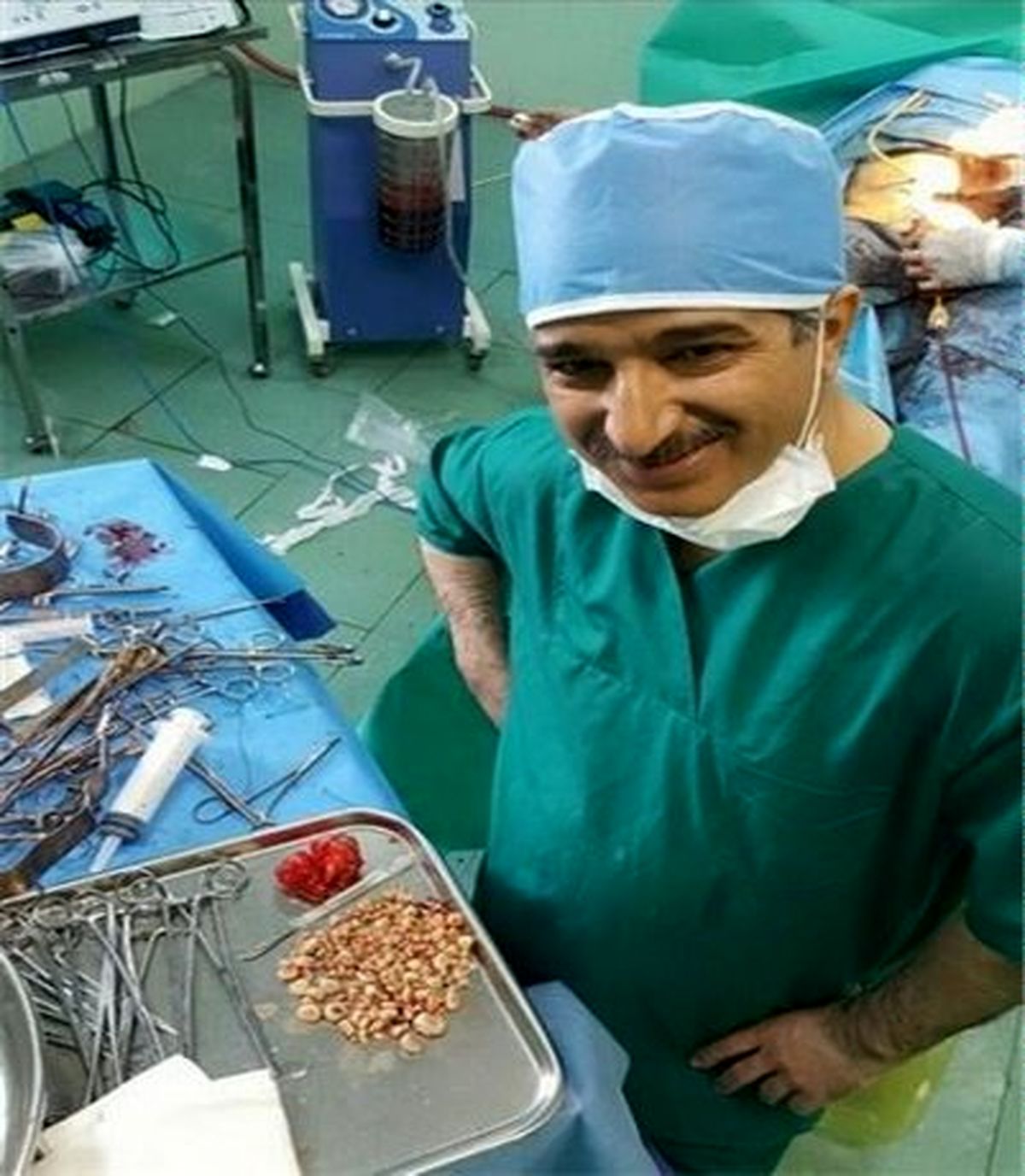 خروج ۲۶۷ سنگ از مثانه یک بیمار +عکس