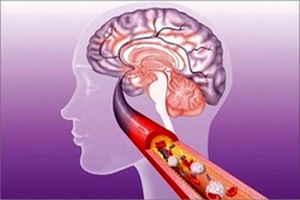 شایع‌ترین علت سکته‌های مغزی چیست؟