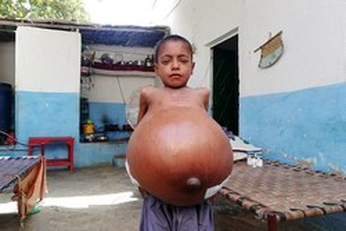 بیماری نادر پسر ۹ ساله +عکس