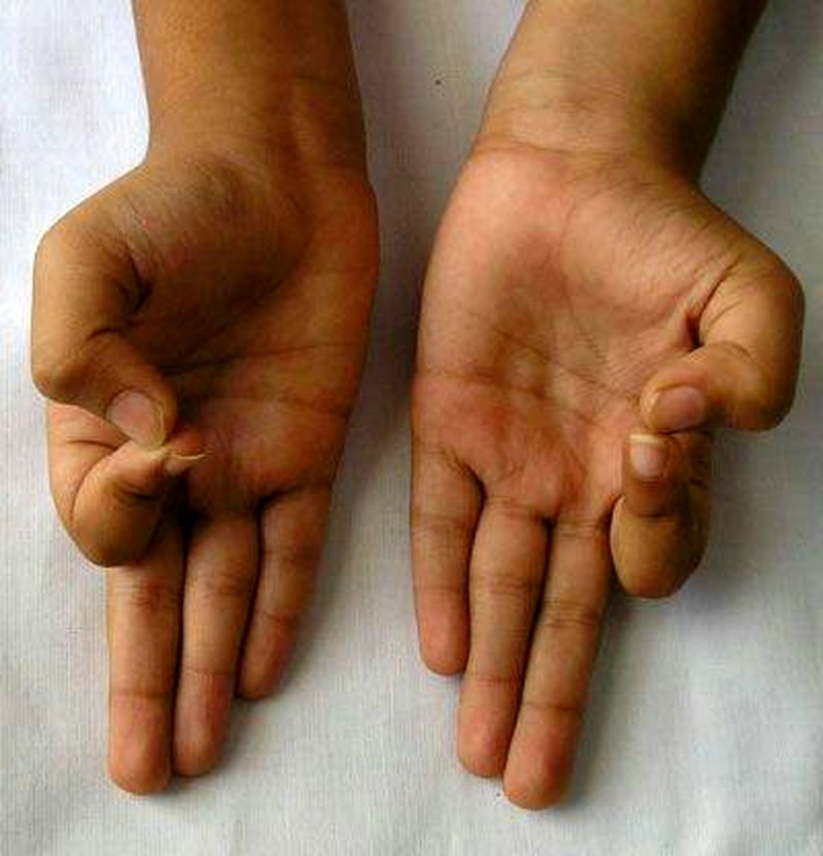 رفع استرس با طب انگشتی هندی +تصاویر