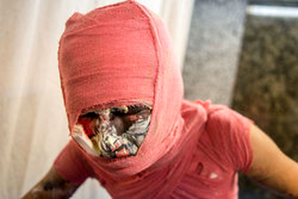 تغییر چهره به دلیل ترقه