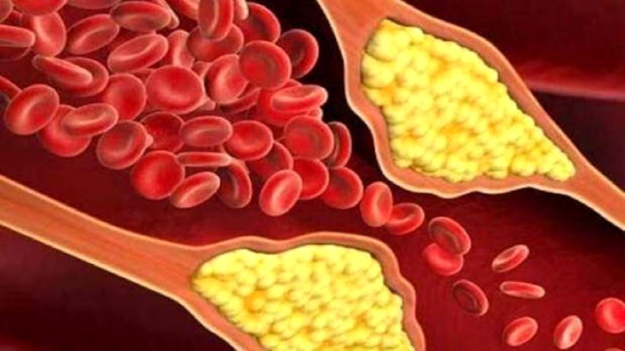 این علائم را دارید کلسترول خونتان بالاست