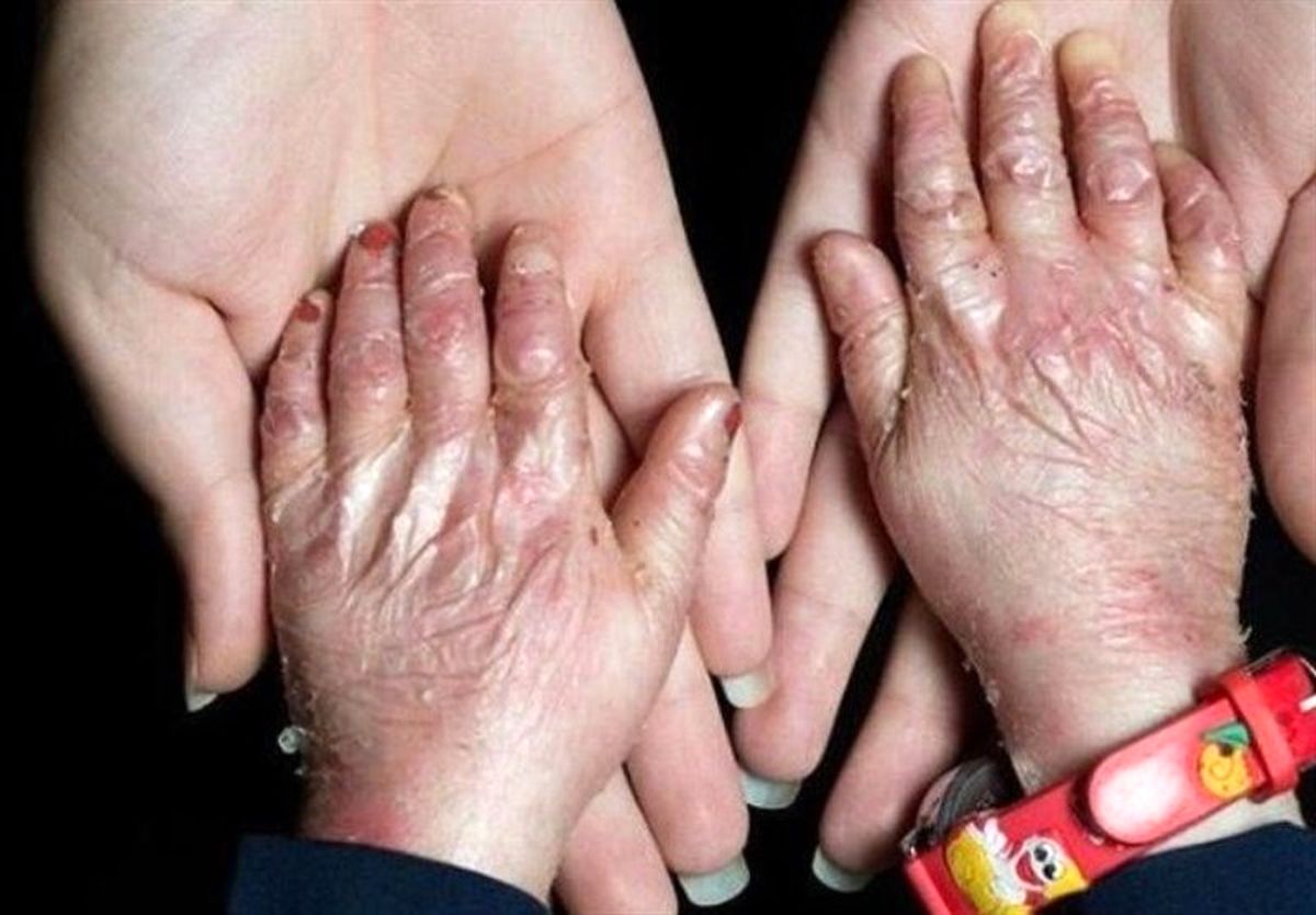 محموله پانسمان بیماران EB در انبارهای وزارت بهداشت!