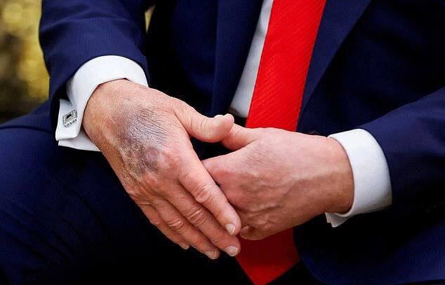 ترامپ از چه بیماری‌هایی رنج می‌برد؟