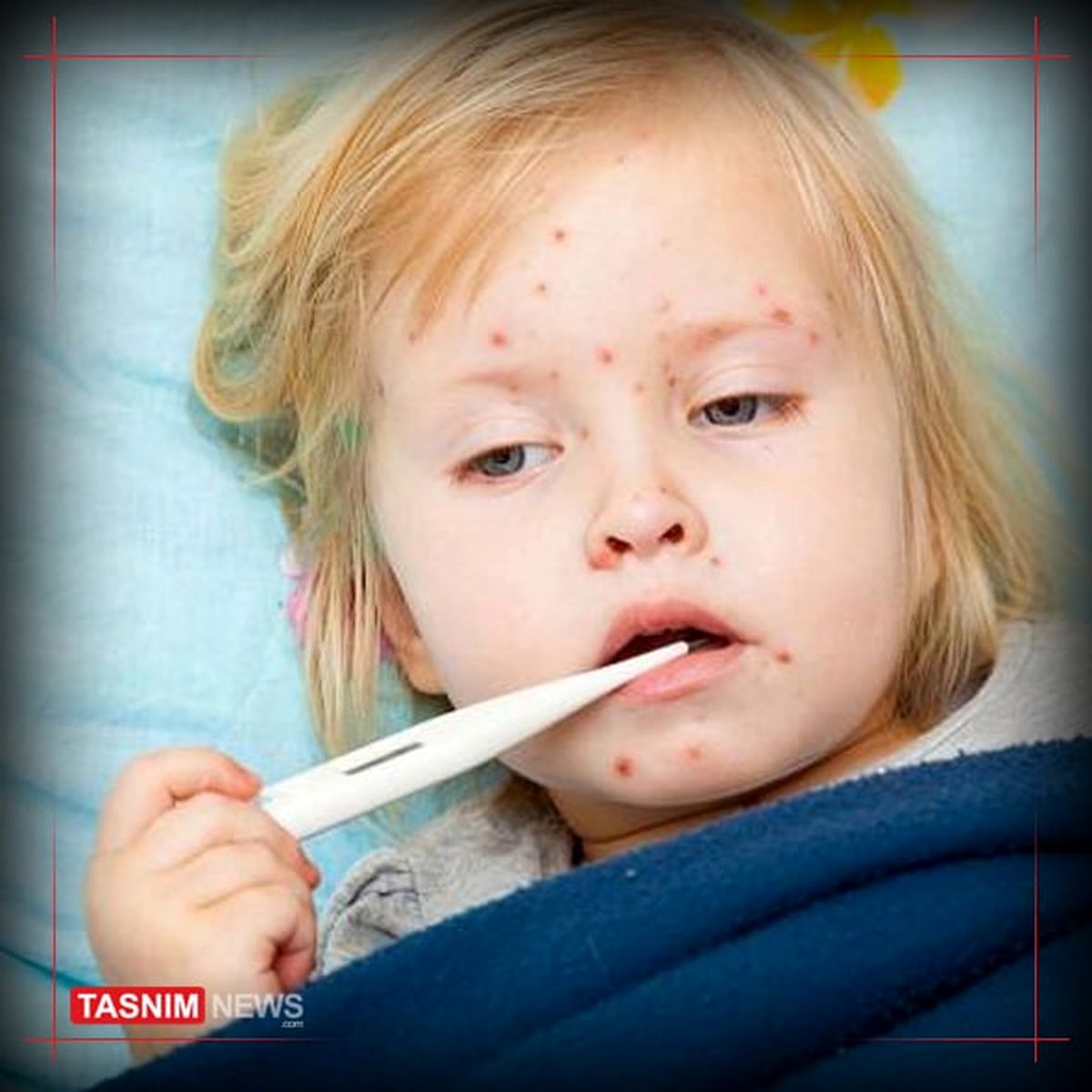 زنگ خطر شیوع سرخک به صدا درآمد / جدیدترین آمار مبتلایان سرخک در کشور