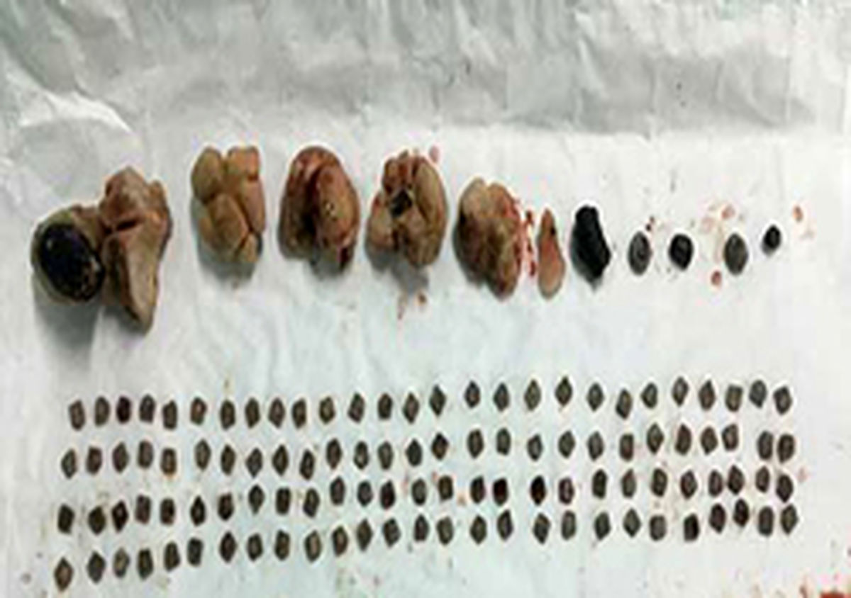 خروج بیش از ۱۵۰ تکه سنگ از کلیه بیمار نی ریزی +عکس