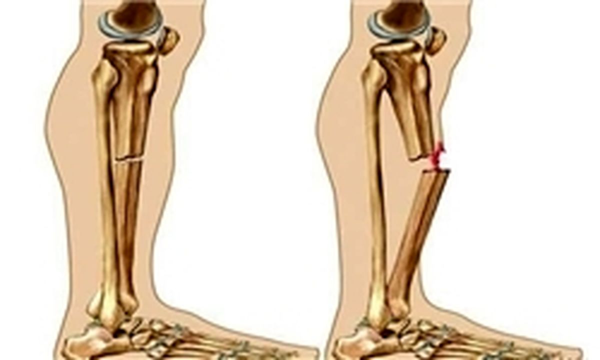 مهم‌ترین دلیل پوکی استخوان چیست؟
