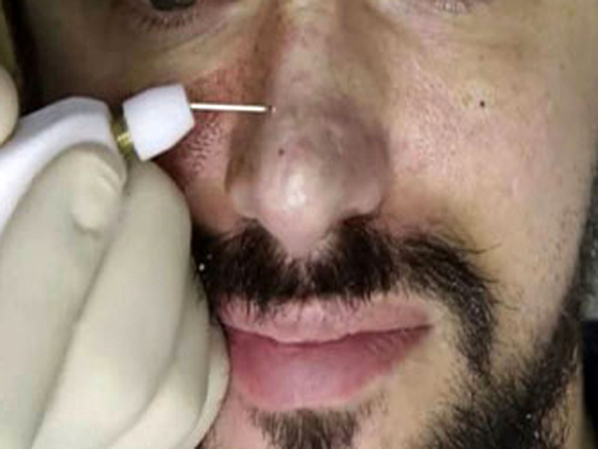 توده‌های وحشتناک روی بینی این مرد خبرساز شد! +تصاویر