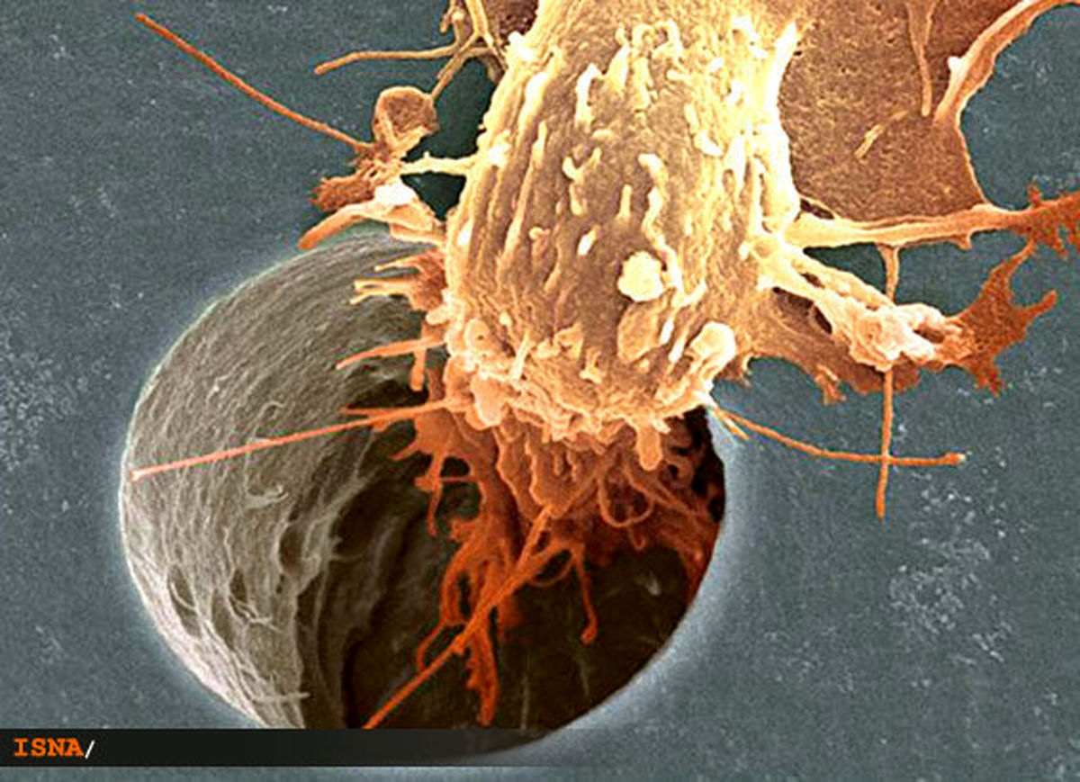بهبود درمان بدخيم‌ترين سرطان مغز با نانوذرات طلا!