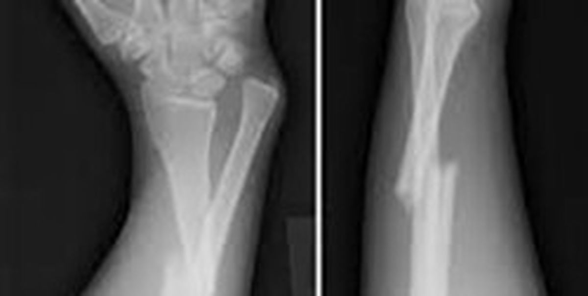 علائم خطر در شکستگی‌ها را بشناسید