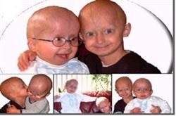 کودکانی که ۶ماهه پیر شدند و مردند!/عکس