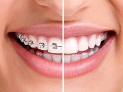 چرا دندان‌ها نامرتب می‌شوند؟