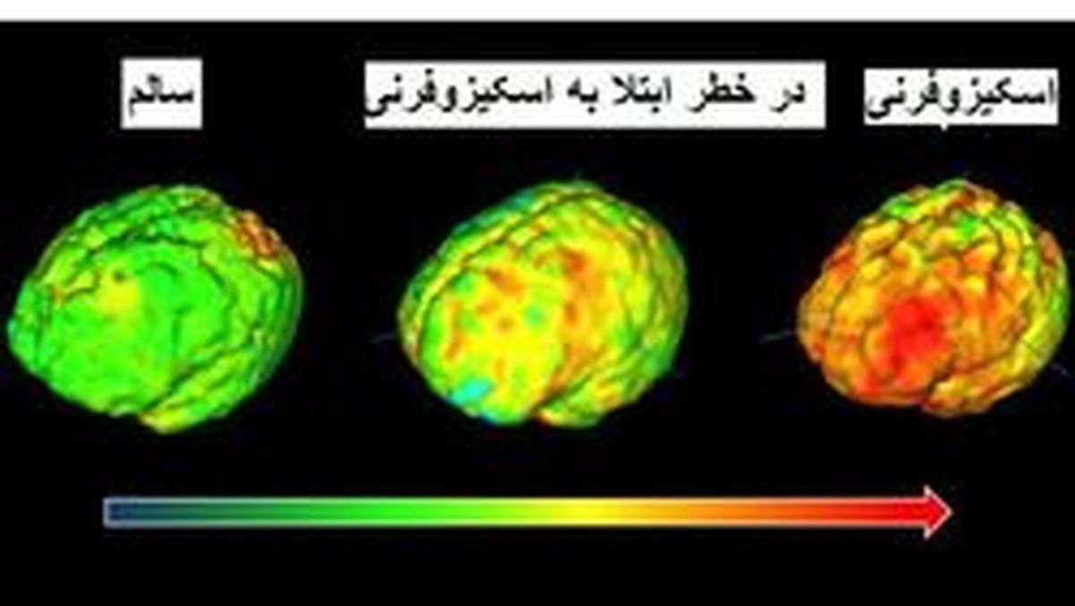 بيماري اسكيزوفرنيا چيست؟