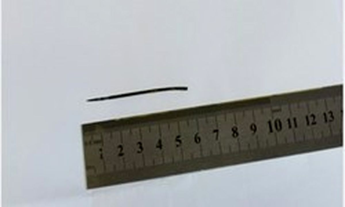 سوزن خیاطی ۶ سانتی در کلیه مرد ۴۴ ساله +تصاویر