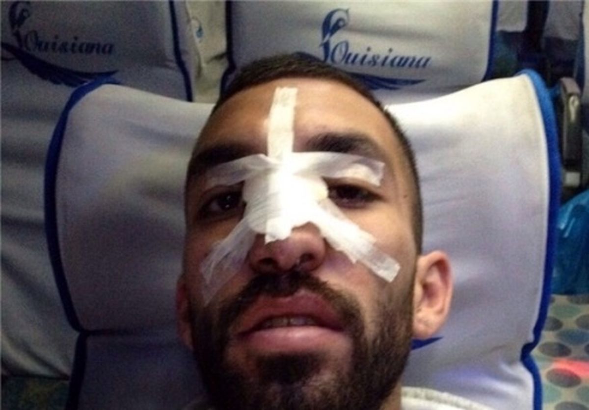 عکسی از بینی شکسته هافبک استقلال در بازی با ملوان