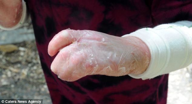 گم شدن ۲۵۰۰ کیلو پانسمان بیماران پروانه‌ای!/ مجلس ورود کرد