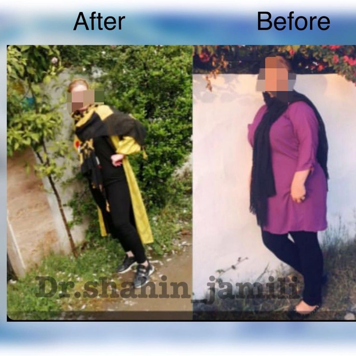 بای پس معده چگونه است؟