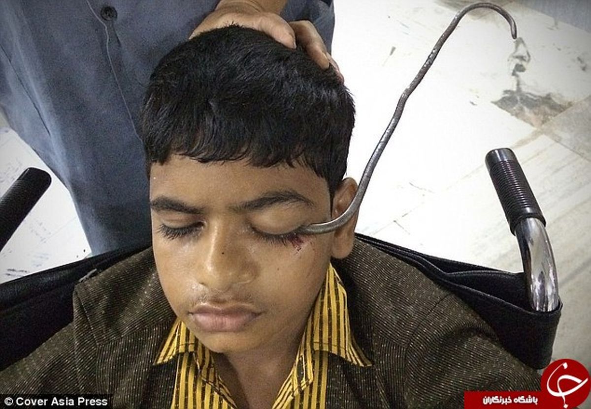 خروج قلاب از چشم و مغز پسر بازیگوش +تصاویر(18+)