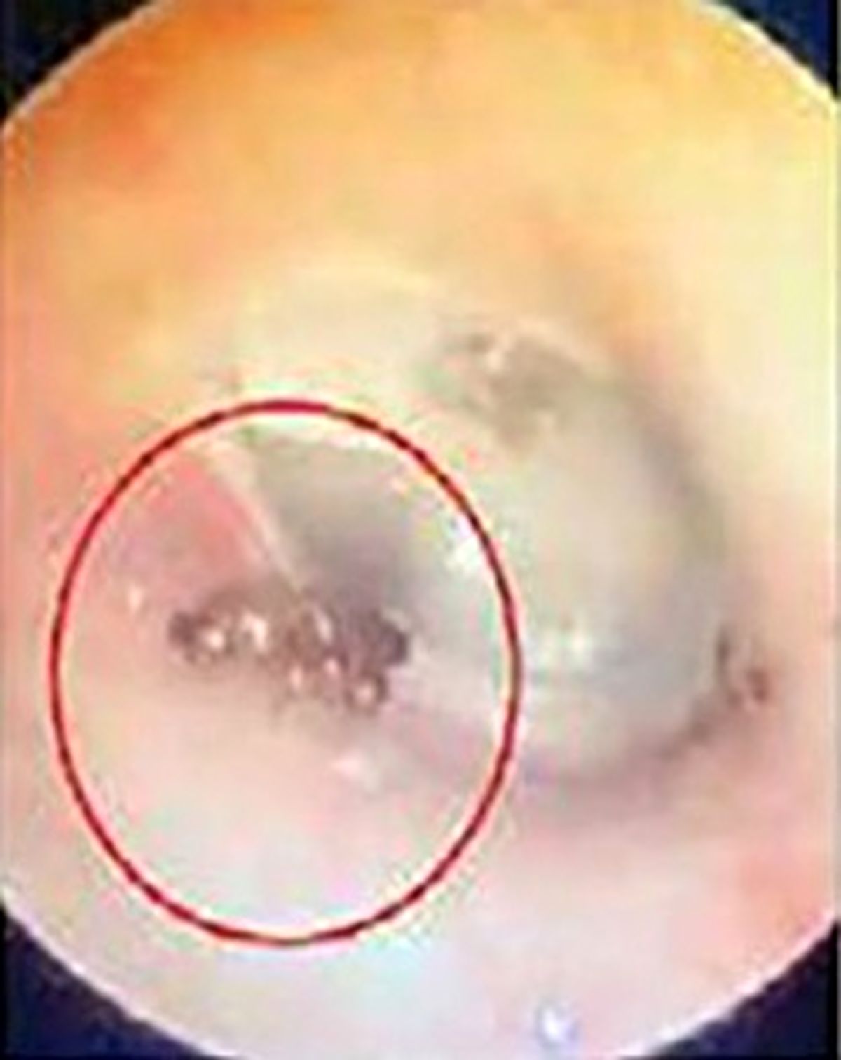 حرکت مورچه‌ در حفره گوش یک مرد +عکس