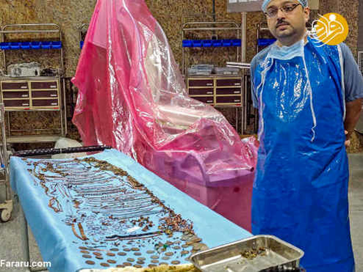 خارج کردن یک و نیم کیلو طلا و جواهر از معده یک زن! +تصاویر