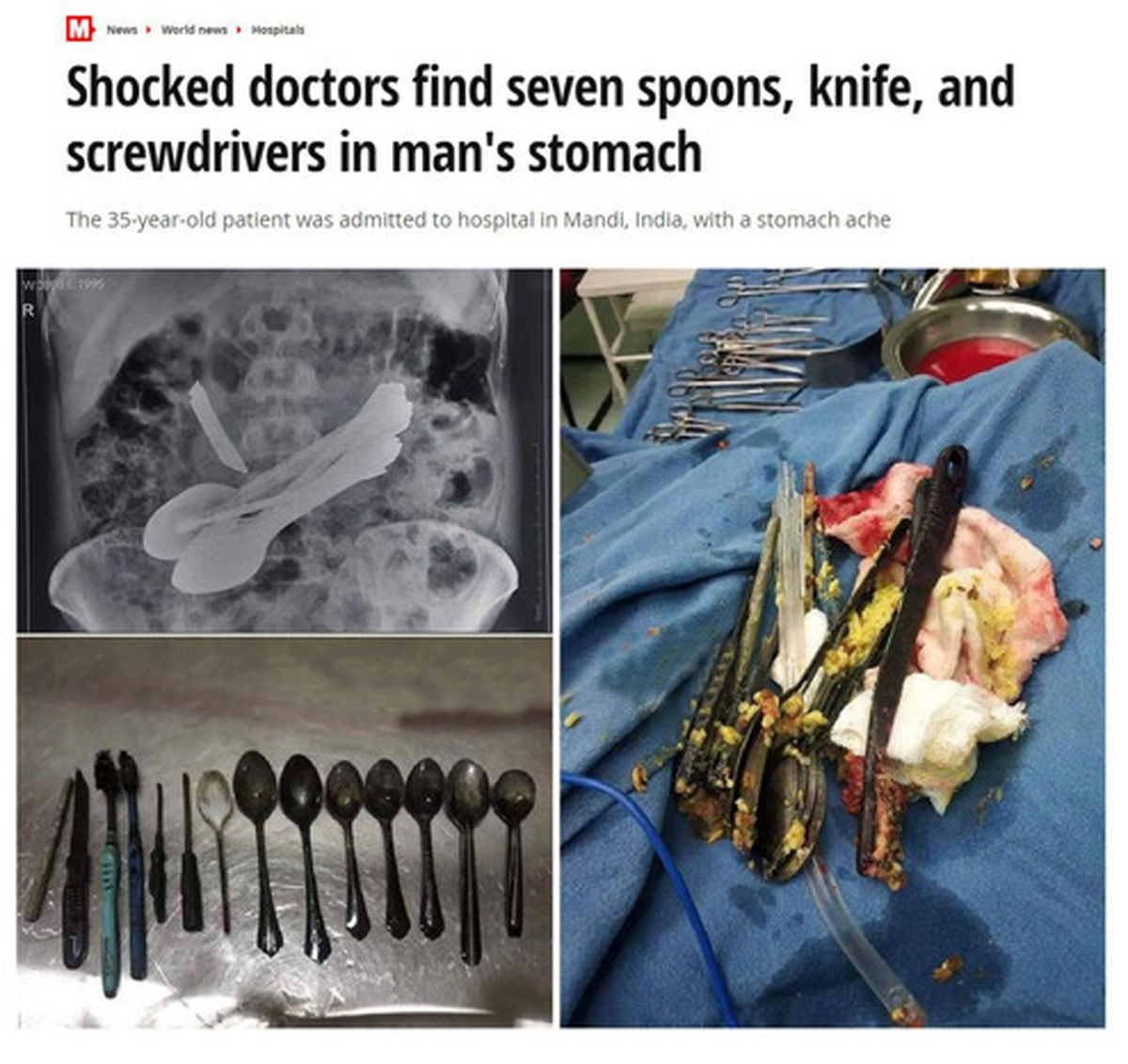 خوردن قاشق و پیچ گوشتی توسط مرد ۳۵ ساله +عکس